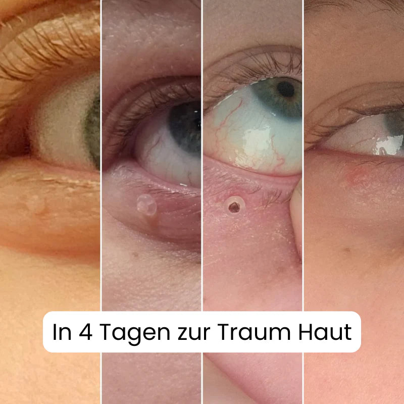 Auto Skin Tag Remover Kit